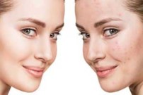 Akne und unreine Haut